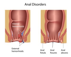 Anal Fistula Fissures abscess Internal Exeternal Hemorrhoids