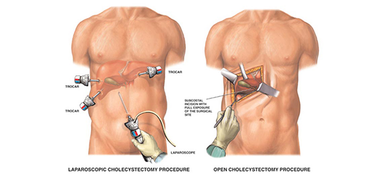 Find out Gall bladder surgery Difference between open and Laparoscopic