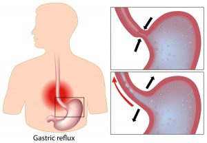 Hiatal Gastric Reflux