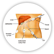 Laparoscopic gall bladder stone surgery