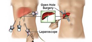 Open Laparoscopic operation to remove gall bladder