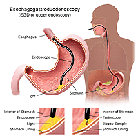 esophago gastro duodeno scopy